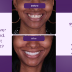 Smile Makeover Cost Explained: What You Get & Is It Worth It?
