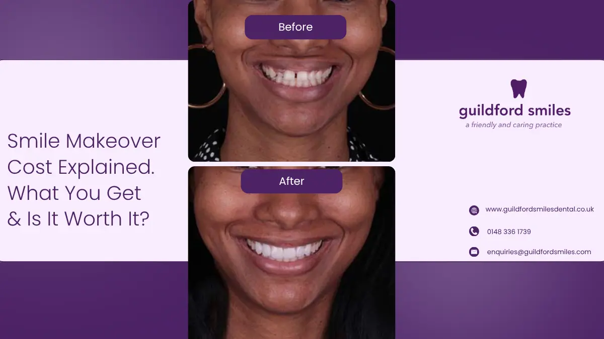 Smile Makeover Cost Explained with cosmetic dentistry treatments, pricing and before-and-after smile transformation results