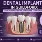 Dental Implants in Guildford