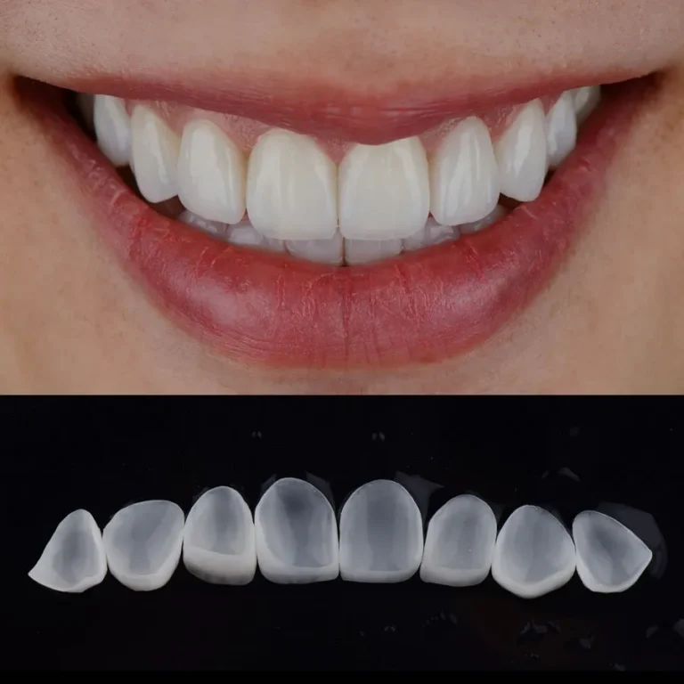Ceramic-Veneers-London-Specialist-Dentists-1