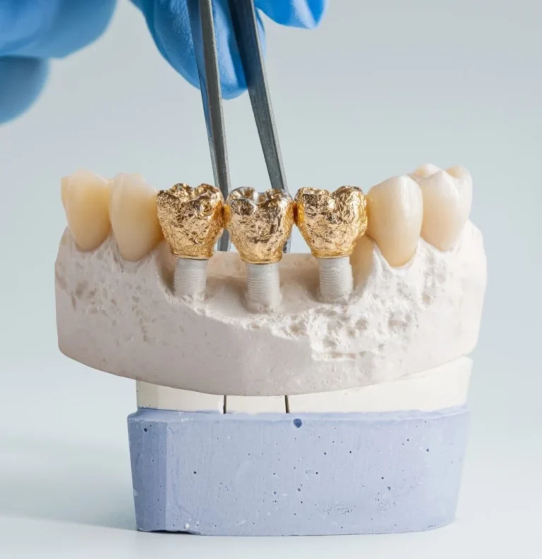 guildford-smiles-dental-denta-crowns-in-general-dentistry
